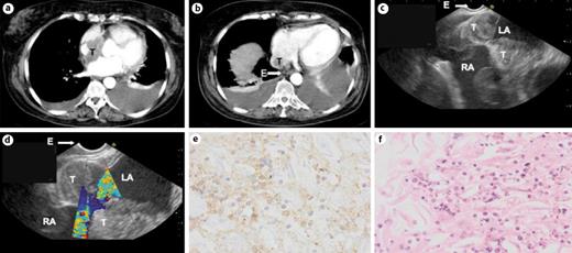 Fig. 1. a, b CT scan of the thorax showing a tumor (T) inside the left atrium, adjacent to the esophagus (E) and a bilateral pleural effusion. c, d EUS images showing the tumor (T) located inside the left atrium (LA) near to the entrance of the right atrium (RA). e, f 19G FNA cytology samples showing cells with enlarged nuclei, little cytoplasm, and some clear nucleolus with blastair aspect, positive for CD20 strain, compatible with Burkitt lymphoma. EUS, endoscopic ultrasound; FNA, fine-needle aspiration.