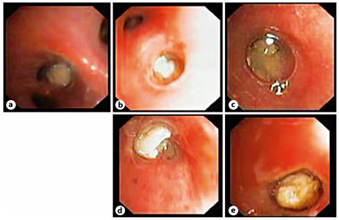 Fig. 1. Different endobronchial obstructions which resemble each other in our patient series: aspirated foreign body(a), endobronchial caseous TB in right lower lobe(b), mucous plug(c), membrane of hydatid cyst(d), and eosinophilic plug in left lingula(e).