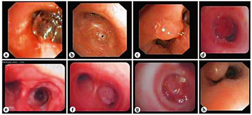 Fig. 2. The pictures of different endobronchial pathologies in our patient series: coagulated mucous plug (a), cicatricial stenosis as a sequela of infection(b), endobronchial TB (polypoid type) in right upper lobe(c), carcinoid tumor(d), submucosal nodule(e), myofibroblastic tumor in right upper lobe(f), aspirated foreign body – a hazelnut (g), and polyp in trachea(h).