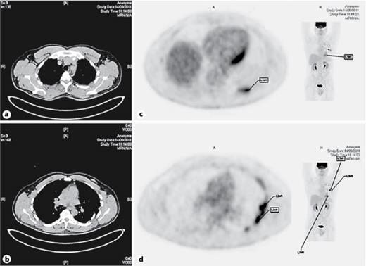 Positive FDG-PET/CT of the Pleura Twenty Years after Talc Pleurodesis ...