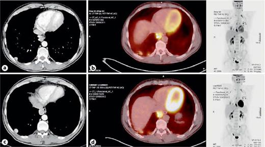 Positive FDG-PET/CT of the Pleura Twenty Years after Talc Pleurodesis ...