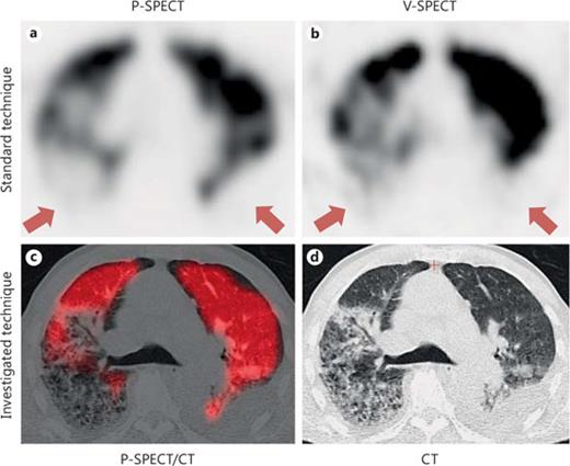 Diagnosis of Pulmonary Embolism: Conventional Ventilation/Perfusion ...