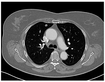 Fig. 1. CT scan of a pulmonary nodule measuring 9 mm in diameter.