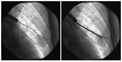 Fig. 3. Pulmonary nodule sampled by fluoroscopic guided bronchoscopy.