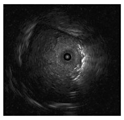 Fig. 4. EBUS displays a pulmonary nodule.