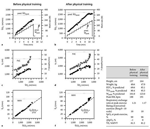 Fig. 3. Results of CPET in a 15-year-old adolescent with CF before and after an individualized 9-month home-based exercise intervention. The data collected are shown in the table. Both tests were maximal. The exercise response prior to the intervention was abnormal in that V∙O2 peak was <82% predicted with no other indicators for an abnormal exercise response. Thus, the patient was deconditioned. Nine months later, after an exercise intervention, the patient had grown and gained weight. Lung function had improved considerably. The exercise response following the exercise intervention was normal, V∙O2 peak had increased considerably even when expressed in percent predicted, indicating an effect of the conditioning and not merely of growth and maturation. a, b ⚫ = V∙O2 peak; - = work rate. c, d ⚫ = VT; ▽ = frequency of breathing (F).