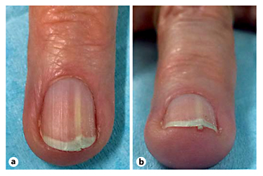Fig. 1. a Left 4th fingernail with a 1-mm white longitudinal band originating from the distal lunula with an associated ridge in the nail plate. b End-on view of left 4th fingernail with a keratotic papule visible at the hyponychium.