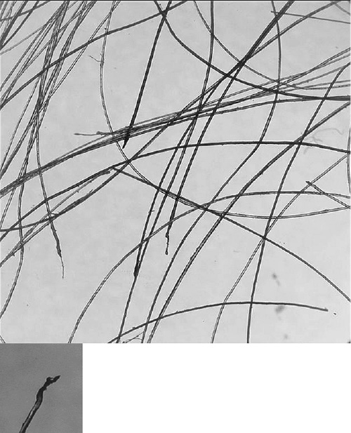Fig. 1. AE of scalp hairs 5 days after the first infusion of docetaxel. Numerous dystrophic hairs are visible. In the small picture, a typical dystrophic root.