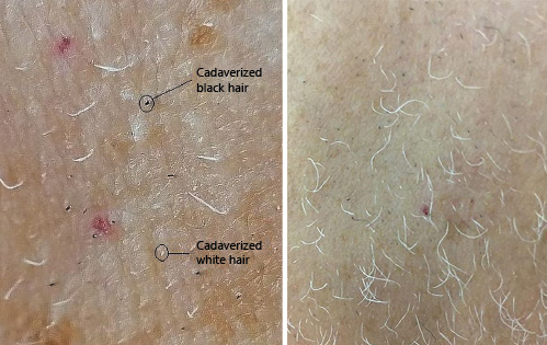 Fig. 2. a Right cheek of the same patient as in Fig. 1, 1 month after the first docetaxel infusion. Empty spaces are clearly visible. Black dots and white dots correspond to hairs that have been truncated at their origin (cadaverized hairs) as the result of AE. Many white hairs have grown up though and seem to be unaffected by dystrophy. b Left cheek, 55 days after the first docetaxel infusion and 3 days after the fifth infusion. Black and white dots are still present. Surviving white hairs are grown up but less than expected. Note the different magnification of the picture. AE, anagen effluvium.