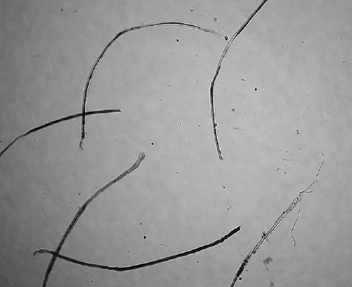 Fig. 3. Some of the white beard hairs in Fig. 1, which have however grown up, have been plucked and examined under a microscope. They were dystrophic hairs, except one possibly telogen hair.
