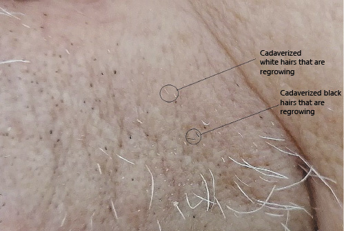 Fig. 4. Left upper lip, 62 days after the first infusion and 10 days after the fifth. There is an evident rarefaction of the hairs, numerous black and white dots (cadaverized hairs) are present that do not seem having grown up. Some of them, instead, have originated short hairs (black circles). Numerous white hairs that have grown up attaining some length are visible. They all are dystrophic hairs (Fig. 3).