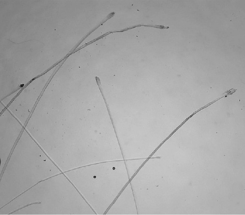 Fig. 5. A tuft of scalp hairs 108 days after the first infusion and 39 after the last one. All hairs have been converted to telogen hairs, although some of them have an irregular shape.