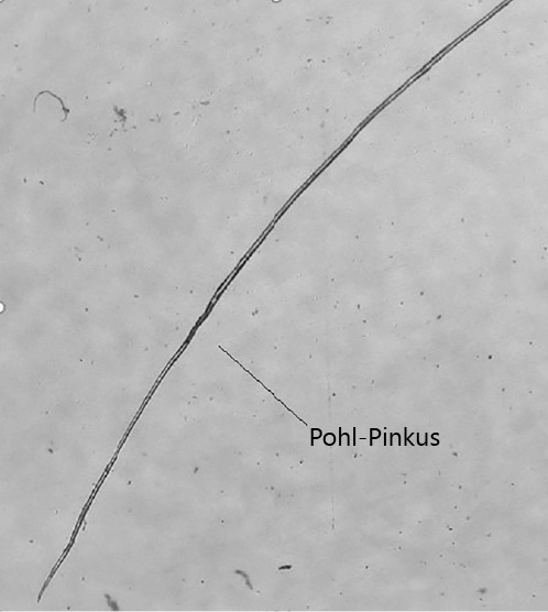 Fig. 6. One of the white beard hairs, which survived the docetaxel infusions, has grown up further (3 months after the first infusion and 4 days before the last one), though severely dystrophic. Note the Pohl-Pinkus constriction (arrow) that probably corresponds to one of the infusions.