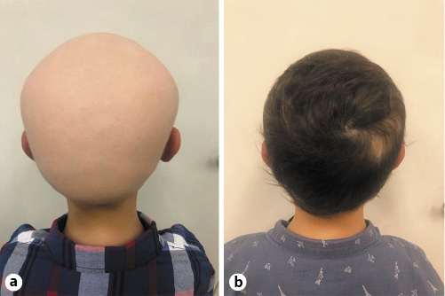 Fig. 1. A 10-year-old patient with alopecia areata universalis before (a) and after (b) 8 months of tofacitinib 5 mg BID treatment.