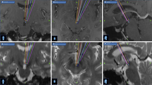 Brain MRI shows DBS target based on coordinates across the studies. Upper row shows T1-weighted scans and lower row shows T2-weighted scans. Black: active contacts in Fontaine’s responders X = 2.98, Y = −3.53, Z = −3.31. Dark Blue: active contacts in Nowacki’s patients X= 3.91, Y = −7.83, Z = −2.96. Green: Piacentino’s coordinates X = 2 from 3rd ventricle lateral wall, Y= −3, Z = −5. Light blue: original coordinates by Leone and used by Nowacki X = 2, Y = −6, Z = −8. Orange: Chabardes’s transventricular approach X= 0, Y= −6, Z = −3. Purple: Seijo-Fernandez’s coordinates X = 4 from 3rd ventricle lateral wall, Y= −2, Z = −5. Red: Franzini’s coordinates X= 2, Y= −3, Z = −5. White: Akram’s ventral tegmentum target based on MRI. The StealthStation™ surgical navigation system was used to generate targets. The MRI slices are at the level of Franzini’s coordinates (Red).