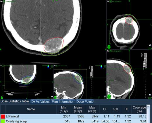 Contour and dosimetric analysis of the lesion (red contour) and the overlying scalp (light green contour) of a 67-year-old female patient with metastatic calvarial lesion, secondary to renal cell carcinoma in the left parietal region. The lesion was treated with marginal dose of 30 Gy in 3 fractions to the 76% isodose line, with a maximum dose of 39.47 Gy. Maximum dose to the overlying scalp was 34.19 Gy. The biologically effective dose (BED) was 73.16 Gy, and the single-fraction equivalent dose (SFED) was 22.51 Gy. During the follow-up, patient experienced temporary patchy hair loss over the radiosurgically treated area. The lesion was locally well controlled for 32 months until the last follow-up.