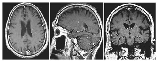 74-year-old gentleman with non-small cell lung cancer and newly diagnosed brain metastasis in the left centrum semiovale treated with SRS (20 Gy). Pre-SRS axial, sagittal, and coronal contrast-enhanced T1 images showing a small contrast-enhancing lesion without perilesional edema identified during follow-up for treatment of the primary cancer.