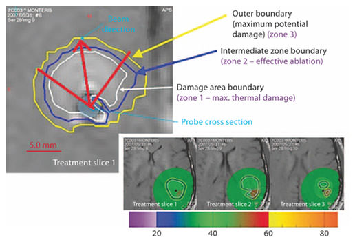 Zones of thermal lesioning: zone 1 (damage area boundary) within the white line being the region of maximal thermal damage, zone 2 (intermediate zone boundary) within the blue line indicating an effective ablation, and zone 3 (outer boundary) within the yellow line indicating temperature changes without any ablative effect. This figure is only representative of the various zones of thermal ablation.