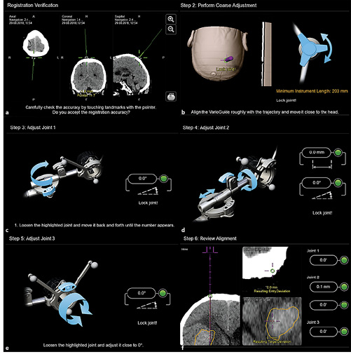 Fig. 1. The accuracy is checked by touching landmarks with the pointer, then the registration is verified (a). After coarse positioning of the head of the unit (b) the three joints (c–e) are adjusted close to 0°. A review of the alignment is displayed, pointing out the calculated entry and target deviation (f).