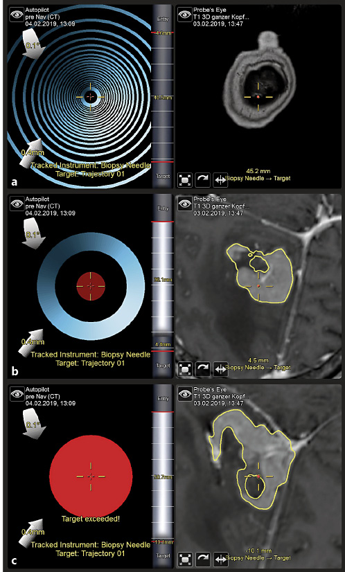 Fig. 2. A precalibrated, navigated biopsy needle is inserted. The navigation monitors display the position of its entry (a), whilst advancing (b), and when reaching and exceeding the target position (c). The autopilot (left in a–c) gives a straightforward feedback on the penetration depth of the biopsy needle, the probe’s eye view (right in a–c) demonstrates the needle within the planned trajectory.