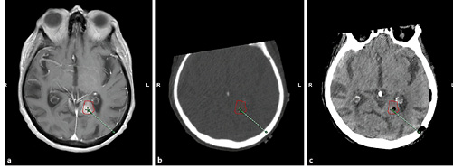 Fig. 3. Documentation of the correct biopsy site: fusion of the preoperative MRI (a), registrational CT (b), and postoperative CT (c) show the instilled air within in the target volume.