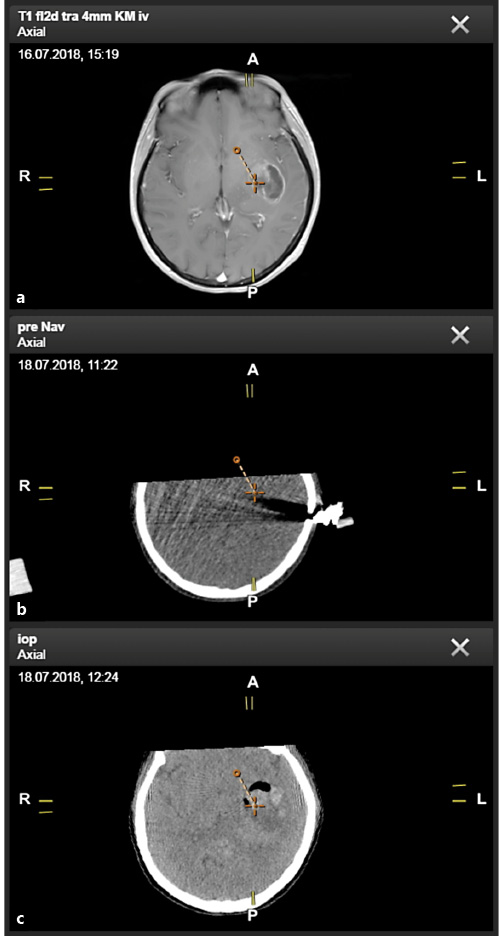 Fig. 5. Case 17: preoperative MRI (a) and navigational iCT (b) do not show any bleeding. The corresponding axial slices of the postoperative iCT (c) document a hemorrhage at the biopsy site.