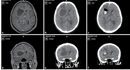 Fig. 6. Illustrative case (No. 6) of a severe hemorrhage detected in postoperative CT in the fiducial group: axial slices of the preoperative MRI (a), CT (b), and the corresponding slices in the postoperative CT (c). d–f Coronal slices of preoperative MRI and CT, and postoperative CT.