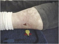 Fig. 2. Abheilendes Ulcus.