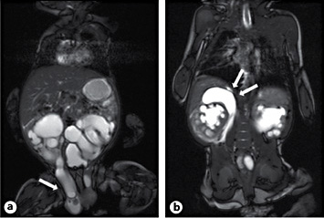 Fig. 1. MRI showing ureteral herniation (a; arrow); b pararenal fluid collection, suspicious for kidney blow out (arrows).