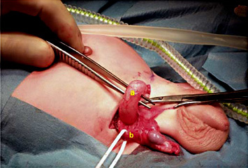 Fig. 2. Ureteral herniation showing ureter (a) and spermatic cord (b).