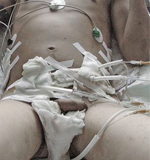 Fig. 1. A Fournier gangrene patient after opening and draining the foci of the scrotum, penis, abdominal wall, hips, perianal area.