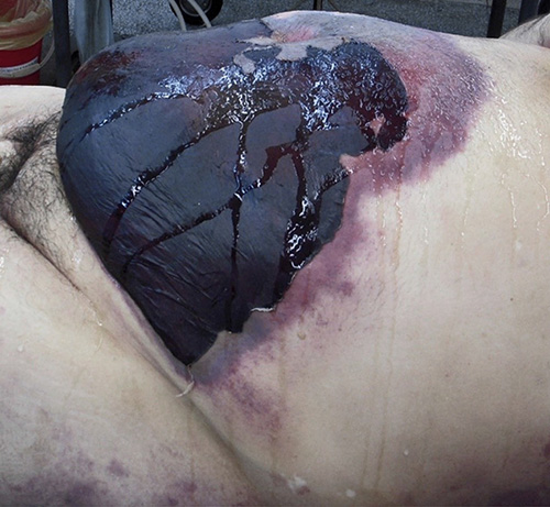Fig. 3. Necrotic cellulite, necrotic fasciomyositis of the anterior abdominal wall of a 56-year-old man.
