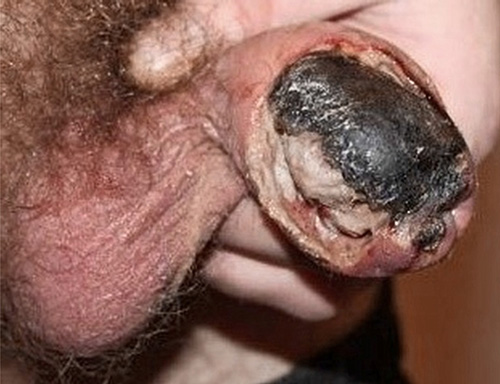 Fig. 4. Complicated hard chancre is phagadenism.