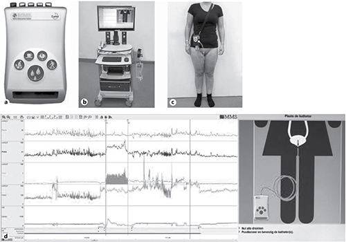 Fig. 1. Ambulatory urodynamic study set-up. a The luna wireless module for registration of events during the ambulatory-UDS. b Solar measurement system. c A patient equipped with measurement catheters and the Luna mobile device. d An example of one part of ambulatory-UDS recording.
