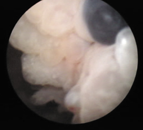 Fig. 1. Blueberry spots on cystoscopy.