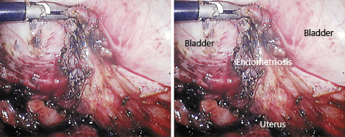 Fig. 2. The light-on laparoscopy image showing forceps pulling up the top of the endometriosis lesion.