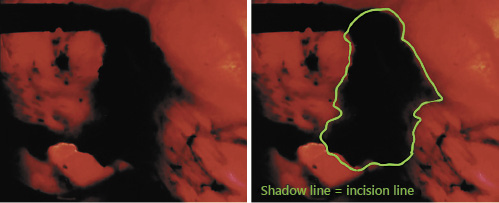 Fig. 3. The light-off laparoscopic image. This is exactly the same image as shown in Figure 2 but with the laparoscopic light source turned off.