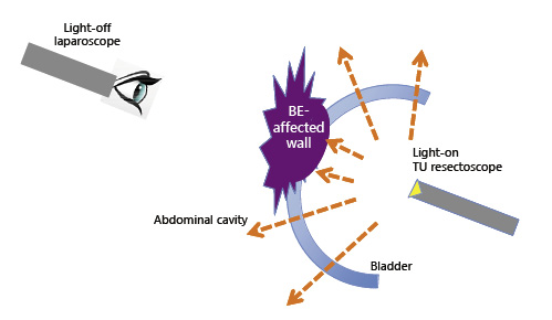 Fig. 4. Sagittal graphic scheme of see-through technique. The light inside the bladder can pass through the normal bladder wall. The edge of the infiltrated lesion is precisely identified by its shade made by the TU resection light source lit inside the bladder (see-through technique).