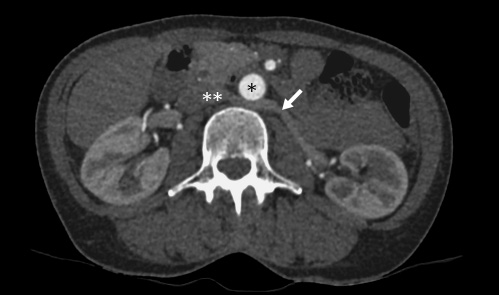 Fig. 1. CT scan of a retroaortic left renal vein. *, aorta; **, vena cava; →, retroaortic left renal vein.
