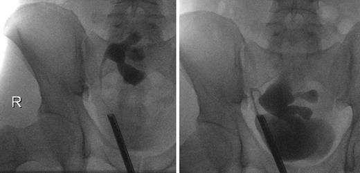 Fig. 2. Ureteropyelogram 6 weeks (left) and 9 months (right) after kidney transplantation.