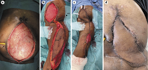 Fig. 1. a Preoperative abdominal tissue defect of patient #2 with an “open abdomen” situation after multiple revisional laparotomies following CCUD (the black arrow points to the umbilical stoma with an indwelling foley catheter) due to a devastated bladder outlet as a complication of radical prostatectomy. After placement of a mesh graft and extensive abdominal wound vacuum therapy, sufficient consolidation of the wound margins was achieved for reconstruction. b Intraoperative identification of the perforator artery. Two anatomic landmarks (black dots: anterior iliac spine and lateral patella) are connected with a thought line. Using a Doppler probe, the perforator artery is identified at a point halfway between the anatomic landmarks on this line (red dot: perforator artery). c The ALT flap is rotated into the defect, and the donor site is closed. Note the remnant skin defect at the donor site (black arrow), which is to be covered with a meshed skin graft. d Result 4-week postoperatively. The umbilical stoma of the CCUD was not compromised by the flap. CCUD, continent cutaneous urinary diversion; AIS, anterior iliac spine; PAT, patella; PERF, perforator artery.