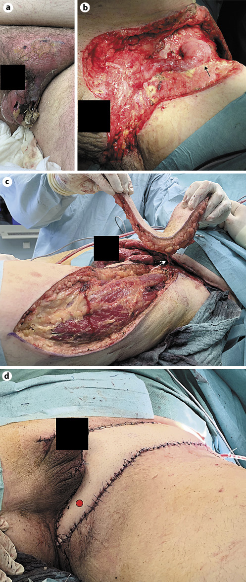 Fig. 2. a Initial presentation of sample patient #6 with Fourniers gangrene involving the left hemiscrotum and left groin. b Consolidated soft tissue defect after hemiscrotectomy and radical debridement/vacuum therapy. Note that the left testis was moved to the inguinal region during tissue consolidation (white arrow). c Intraoperative appearance of the raised ALT flap. The white arrow points at the perforator artery. d Immediate postoperative result after rotation of the ALT flap into the defect. Before closure, the left testis was moved to the lowest possible point (red dot) of the defect. Here, after wound consolidation, revisional surgery with the creation of a left neoscrotum is planned. ALT, anterolateral thigh perforator.