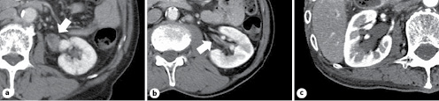 Fig. 1. Classification based on the initial CT findings. Tumor-like lesions (arrow); Group A (a), wall thickening (arrow); Group B (b), hydronephrosis; Group C (c). CT, computed tomography.
