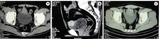 Fig. 1. a–c CT images show a solid mass in the dome of the bladder with calcification. CT, computed tomography.