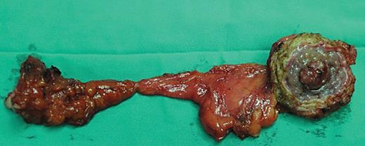 Fig. 2. The resected specimen of umbilical, urachus, and urachal carcinoma.