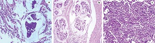 Fig. 3. a Urachal adenocarcinoma, mucinous type. b Urachal adenocarcinoma, signet ring cell type. c Urachal small cell carcinoma (HE.; original magnification ×200).