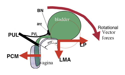  The detailed anatomy of urethral closure in the female as described in 1990 [1]. The PUL inserts into the midurethra and vagina. The PVL has the same origin as the PUL; it inserts into a thickening of the anterior bladder wall called the “arc”. On effort, the PCM contracts forward against the PUL to stiffen the posterior wall of the distal vagina; the LP pulls back against the PUL to stiffen the PVL and proximal urethra; the conjoint longitudinal muscle of the anus (LMA) pulls down against the uterosacral ligament (not shown here) to rotate the bladder around the arc (broken lines) to close (kink) the urethra at the bladder neck. The vagina between the PUL and bladder base “ZCE” is elastic, so it can stretch bilaterally to allow the distal (PCM) and proximal (LP/LMA) closure mechanisms to operate separately. PVL, pubovesical ligament; arc, precervical arc of Gil-Vernet; PCM, pubococcygeus muscle; LP, levator plate; ZCE, zone of critical elasticity.