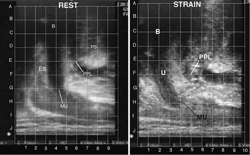  Three reflex muscle forces, backward, downward, and forward close the male urethra as in the female. Left at rest. The lower level of ES is at G4. MU runs between G4 and H7. Right during straining. The lower level of ES is now between H and I and 2.5. PPL has stretched considerably backward, from E6.5 to G4.5, almost double, indicating weakness; MU has moved slightly forward. ES, external sphincter; PS, pubic symphysis; B, bladder; MU, membranous urethra.