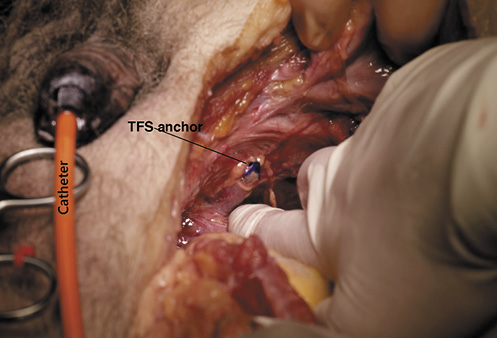 Position of the TFS anchor in the PPL. When the TFS was inserted into the male cadaver using the exact technique used in the female, the anchor exited in the position of the PPL.