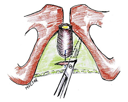  Incision of the perineal membrane. Tunneling with scissors.